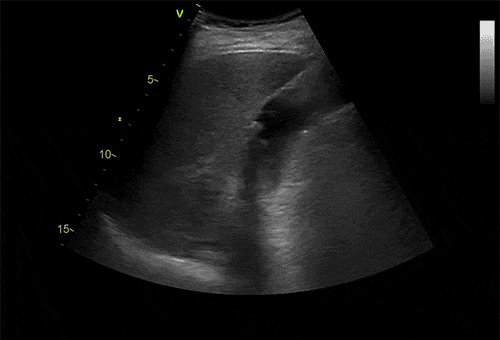Animation einer Gallensteine Ultraschall Sequenz